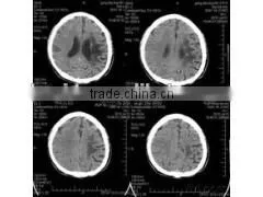 Medical Film From Manufacturer,x Ray Film,dry Imaging Film Printed With Fuji and Agfa Printers thumbnail-1