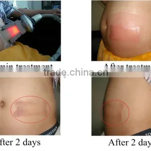 Cavitation Multipolar Tripolar Rf Slimming Body Slimming Machine Fat Reduction Machine For Beauty 5 In 1 Cavitation Machine thumbnail-5