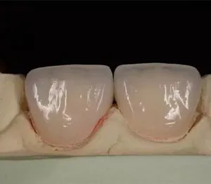 The Telescopic Crown Precision Attachment Denture Has Strong Stability thumbnail-5
