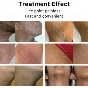 Laser Hair Removal Machine With 1-Year Warranty and Training thumbnail-5