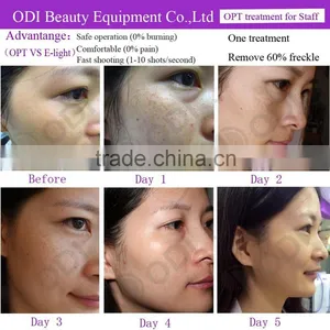 Optimal Pulse Technology OPT Shr Ipl Permanent Facial Hair Removal for Women Clinic Skin Whitening Treatment thumbnail-6
