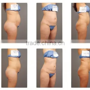 Permanent Body Slimming Ultrashape/Best Slimming Machine Ultrashape/High Quality Ultrashap Machine for Salon thumbnail-6