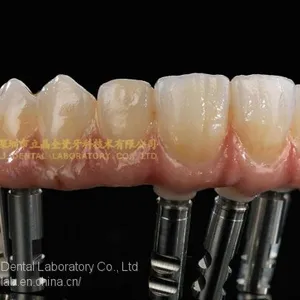 Full-arch Implant Bridge Prosthesis, Implant Denture Framework, Implant Prosthesis, Laboratoire Dentaire, Dentallabor, Laboratorio Dental, Dental Laboratory, Shenzhen LJ Dental Lab China thumbnail-5