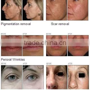 Medical RF Tube Fractional CO2 Laser Vaginal Tightening Gynecology Laser thumbnail-3