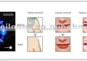Q-switched Ndyag Laser,professional for Tattoo,pigment ,eyebrow Removal thumbnail-4