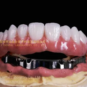 Dental Implant Bar, Implant Overdenture, Implant Prosthesis, Laboratoire Dentaire, Dentallabor, Laboratorio Dental, Dental Laboratory, Shenzhen LJ Dental Lab China thumbnail-3