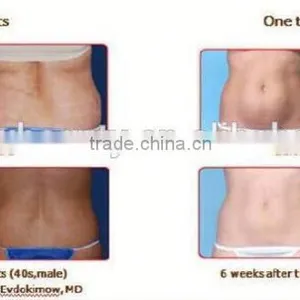 Fat Freezing Body Slimming System M-C201 thumbnail-6