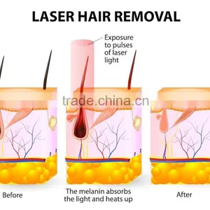 Permanent Laser Hair Removal Machines Home thumbnail-2