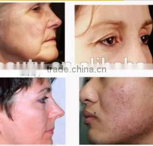 AYJ-M08 Home Use Microneedle Fractional Rf, Double Chin Removal Machine thumbnail-6