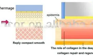 Companies Looking for Distributors in Africa Portable rf Cavitation / Fraction rf thumbnail-2