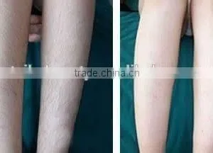 Multifunction Portable Ipl Shr Breast Lifting Up Laser Hair Removal Machine thumbnail-4