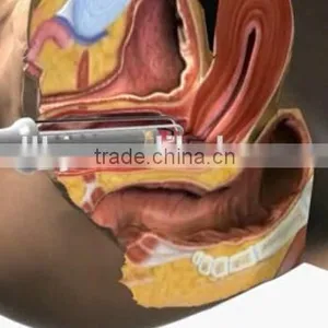 Tumour Removal Factory Price Vaginal Tightening Fractional Co2 Laser / Medical Portable Warts Removal Fractional Laser Co2 Vaginal Tightening Machine Acne Scar Removal thumbnail-5