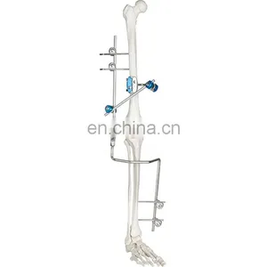 Guaranteed Quality Medical Bone Surgery Hoffmann Knee Joint External Fixator Orthopedic Surgcal Instruments thumbnail-1