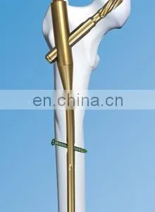Orthopedic Trauma Implants PFNA thumbnail-2