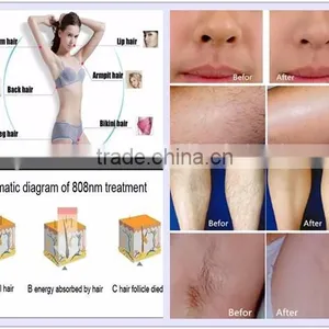 50-60HZ Newest 808nm Diode Laser Hair 1-800ms Removal Machine/808nm Diode Laser Hair Removal thumbnail-5