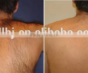 1500mj Vertical ND YAG Long Pulse Laser No Pain Hair Removal Beauty Machine 0.5HZ thumbnail-6
