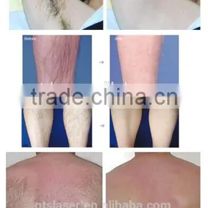 755 Alex Laser ,Hair Removal & Skin Rejuvenation Alexanderite Laser Machine thumbnail-4