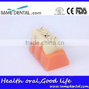 4 Times the Cavities Progress Model Dental Eduction Assitant No. DEA-16 thumbnail-3