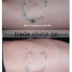 1 HZ Q Switch Laser Tattoo Removal Machine For Skin Tattoo Treatment 1-10Hz thumbnail-3