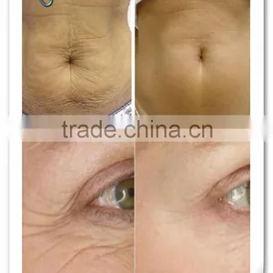 Advanced 2 in 1 Fractional Micro Needle RF Thermagic RF Microneedle for Deep Anti-aging and Wrinkle Removal thumbnail-6