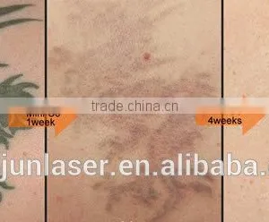 ND Yag Laser Tattoo Removal Machine Vascular Tumours Treatment Mini Q Switch ND Yag Laser MINI-C6 Tattoo Laser Removal Machine thumbnail-5