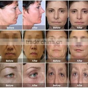 Latest Young Hifu Slim Beauty Weight Loss Equipment Portable Version With 5 Heads thumbnail-5