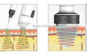 Popular MAGIC COOL Model HS-570 Cryo Electroporation thumbnail-2