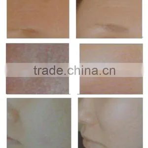 Eye Wrinkle / Bag Removal Professional Portable Co2 FDA Approved Laser Warts Removal Tube/co2 Fractional Laser Machine 0.1mj-300mj thumbnail-6