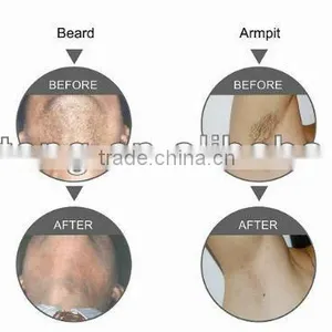 Promotion Machine SHR Machine Permanent Hair Removal thumbnail-4