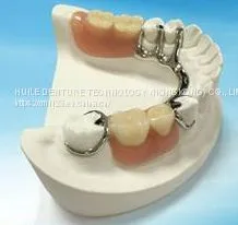 Dental Pfm Crown From China Dental Lab thumbnail-1