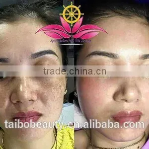 0.5HZ 2016 Professional Tattoo Removal Laser Machine Q-switched Nd Yag Laser/nd Yag Laser Prices/cosmetic Nd Yag Laser Machines Prices Q Switch Laser Tattoo Removal Machine thumbnail-6