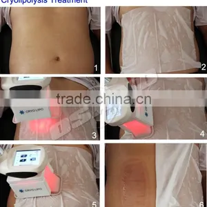 Mini Cryolipolysis For Home Use thumbnail-5
