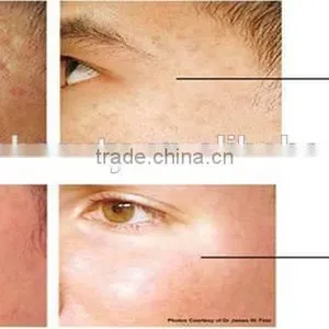 2016 Express Micro Needle rf / Fractional rf Microneedle Sale /radio Frequency Wrinkle Removal and Skin Rejuvenation thumbnail-6