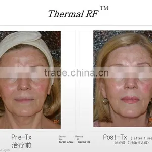 Fractional rf Micro Needling Wrinkle Removal Machine From Beauty Salon Equipment Supplier thumbnail-5