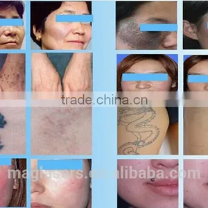 Skin Tightening Co2 Fractional Laser Skin Remove Neoplasms Rejuvenation Machine/laser Co2 Vaginal Treatment Machine 10.6um 8.0 Inch thumbnail-6