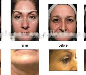 No-needle rf Skin Instrument for Facial Care Wrinkle Removal and Skin Tightening Whitening thumbnail-4