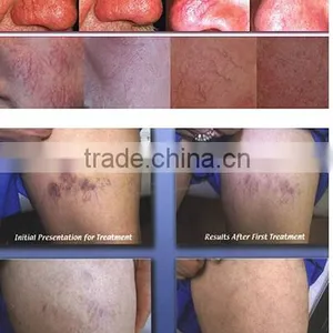 1500USD Promotion Price High Frequency Vein Needles/spider Vein Removal Machine thumbnail-6