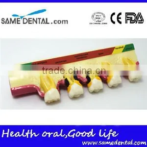 2x Periodontal Disease Classification Models Dental Eduction Assistant No. DEA-20 thumbnail-1