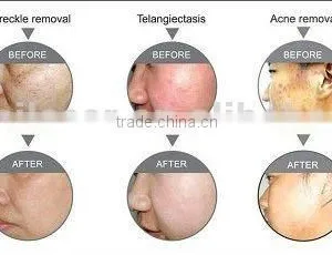 Multifunctional Best Wrinkle Removal Machine/ Ipl rf Beauty Machine thumbnail-6