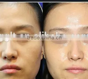 Best no Needle Cooling RF Skin Beauty Machine for Home Use thumbnail-5