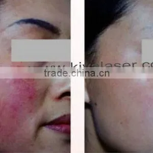 Upgraded Power Board! Vascular Removal Laser thumbnail-5