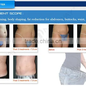 Nasolabial Folds Removal Non-surgical 500 000 Shots Warranty 1cm2 Spot High Frequency Machine Facial Size High Intensity Focused Ultrasound Ultrashape Hifu Body Slimming Machine High Frequency Esthetician Machine thumbnail-6