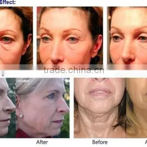 AYJ-T28 Dot Matrix RF Wrinkle Removal Machine thumbnail-4