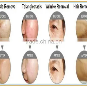 High Power Laser SALON/SPA Use Fast Hair Removal Ipl Shr Machine thumbnail-6