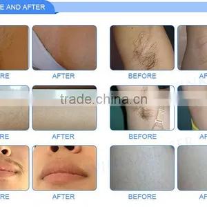 High Quality Vertical Espil Ipl Hair Removal for All Skins thumbnail-4