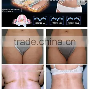 2015 Radio Frequency Rolling Guangzhou Beauty FSWT Machine Wholesaler thumbnail-3