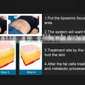 Nasolabial Folds Removal Liposonix High Intensity Focused High Frequency Acne Machine Ultrasound HIFU Body Slimming Machine Face Lifting thumbnail-6