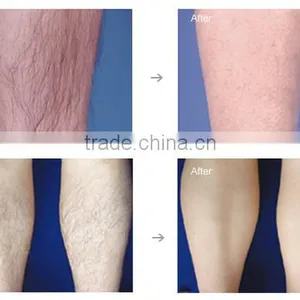 e Light Ipl rf nd Yag Laser Spot and Freckle Removal Machine thumbnail-4