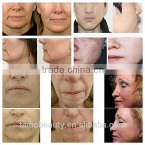 Professional Microneedle Rf/best rf Skin Tightening Face Lift Machine/micro rf Deep Wrinkle Removal thumbnail-6