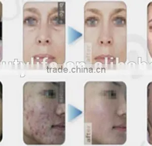 Unique Design Portable IPL Laser Hair Removal Machine thumbnail-6